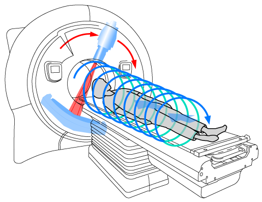 Radioterapia helicoidal